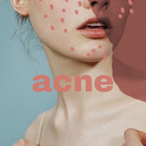 acne square 1