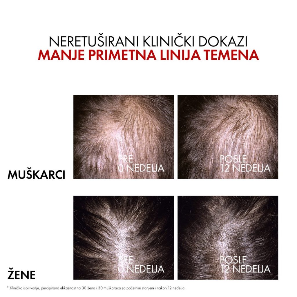 Psihologija iza gubitka kose: Opadanje nije samo estetski problem 9 gallery4